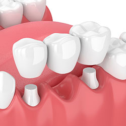 Illustration of a dental bridge supported by prepared neighboring teeth