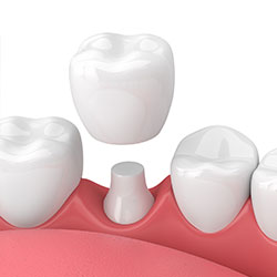 Illustration showing a dental crown placed over a prepared tooth