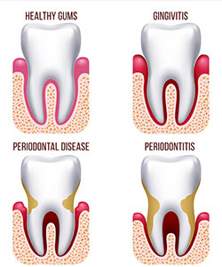 Illustration comparing periodontal disease and periodontitis around a tooth