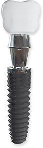 Expanded illustration of a dental implant, abutment, and crown