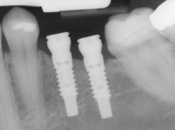 Dental X-ray showing two implants positioned in the jaw