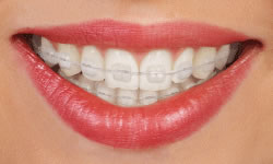 Clear ceramic braces on teeth