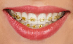 Gold-coated braces on teeth