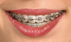 Self-ligating braces with specialized clips