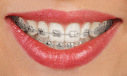 Traditional metal braces on teeth