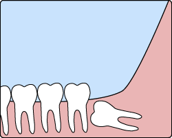 Illustration showing an impacted wisdom tooth angled toward the neighboring molar